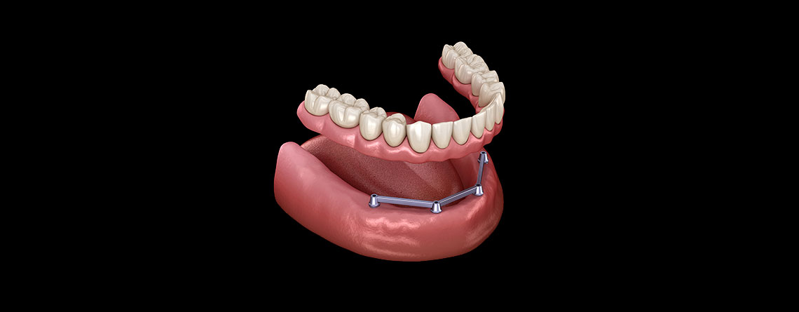 apex diş all ın four