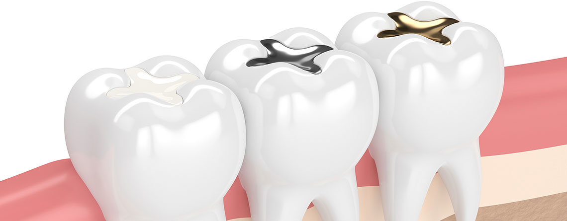 apex dolgu ve konservatif