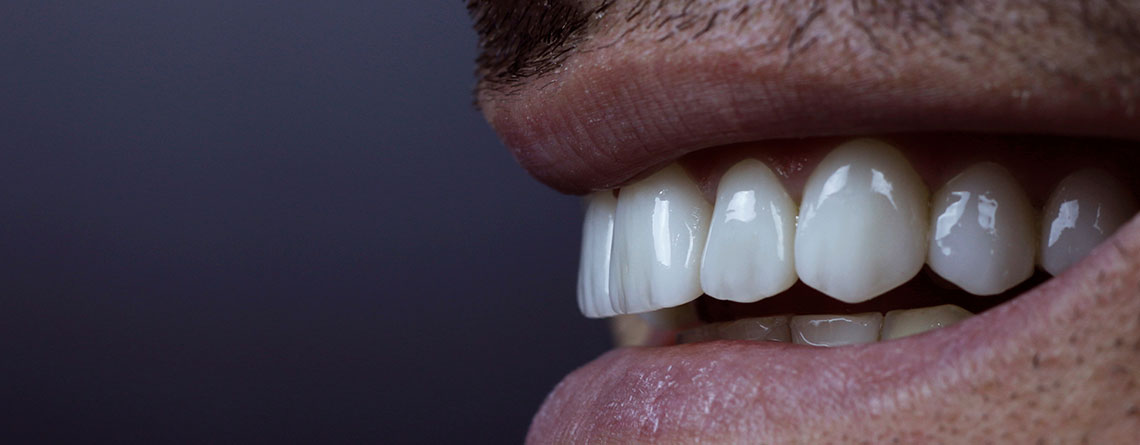 apex gülüş tasarımı