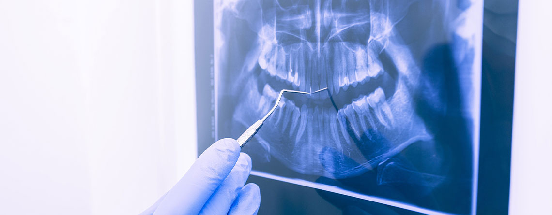 oral diagnoz apex dis
