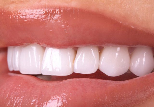 implant diş bakımı ve önemi